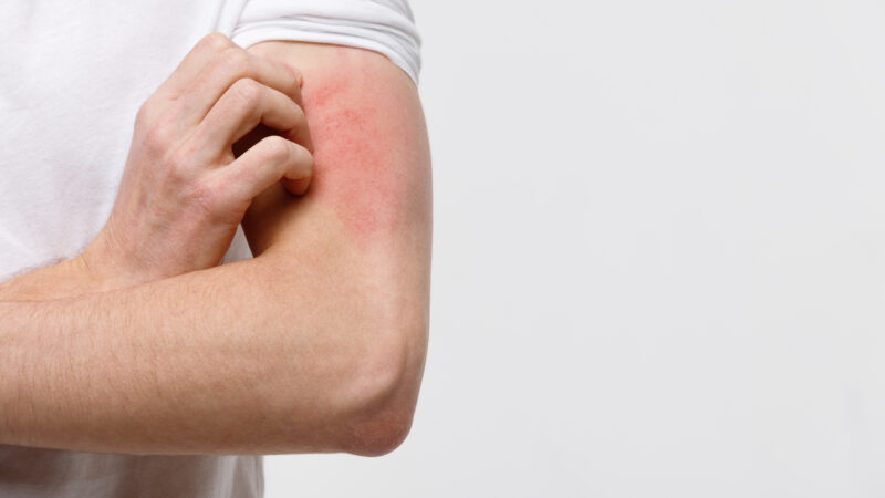 La dermatitis atópica impacta el bienestar social y emocional de quienes la padecen